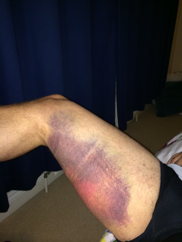 Hamstring Tear - Player returned to play after rehab!