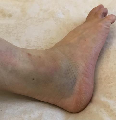 Ankle Sprain