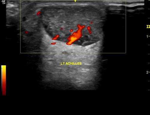 Achilles tendinopathy evident on Power Doppler