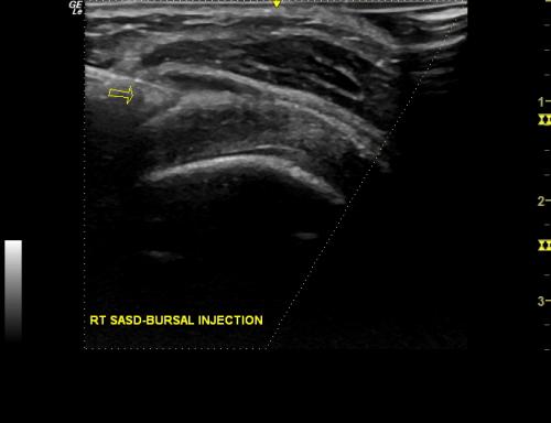 Sub-acromial Impingement Injection